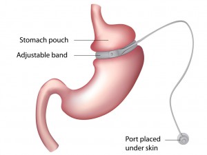 gastricband