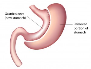 gastricverticalsleeve