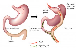 roux-en-y gastric